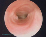 Post-reconstruction view of airway during MLB showing widely patent airway.