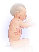 Why Choose CHOP’s Esophageal and Airway Treatment Program