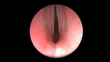 glottic stenosis