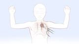 Illustration shows two incisions made in a hyperhidrosis surgery procedure called thoracoscopic sympathectomy
