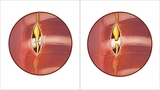Illustration shows the sympathetic chain and where it is cut during surgery for hyperhidrosis