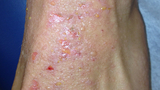 impetigo