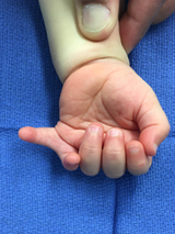 Kaylee's extra pinky on right hand