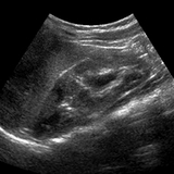Left kidney showing a duplicated collecting system
