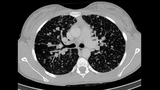 CT scan of thyroid before Lenvatinib use