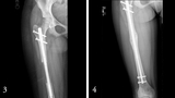 limb lengthening technology xrays