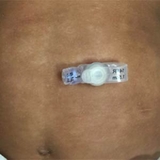 Low-profile gastrostomy tube (button)