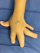 Hand with macrodactyly