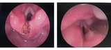 Endoscopic laryngeal cleft repair 