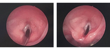 Repeat microlaryngoscopy, bronchoscopy repair