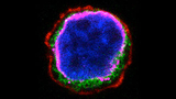 Photograph of an acute lymphoblastic leukemia cell Photograph of an acute lymphoblastic leukemia cell