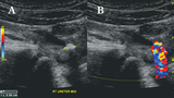 Ultrasound image of kidney stone in the mid right ureter