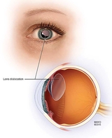 Pediatric Aphakia And Where To Place An Intraocular Lens - Figure 5