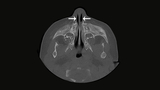 pyriform aperture stenosis