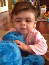 Saethre-Chotzen Syndrome and Encephalocele: Elana’s Story - Baby