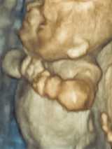 upper skeletal dysplasia
