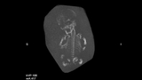 skeletal dysplasia CT