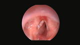 subglottic hemangioma