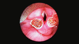 supraglottoplasty airway