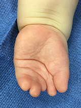Hand with symbrachydactyly