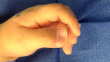 Thumb duplication, Wassel stage I