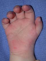 Thumb Hypoplasia Before Surgery