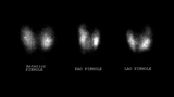 Thyroid Uptake Scan Image