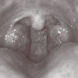 tonsils