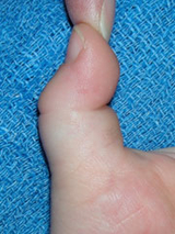 Trigger Thumb
