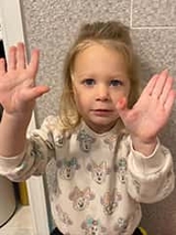 Madelyn showing her hands, pre-surgery