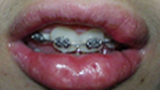 Van Der Woude - lip pits revision patient