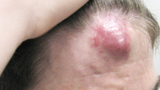 Arteriovenous Malformations Image