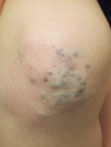 Glomangiomas Image