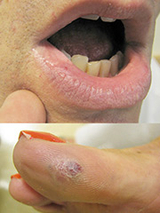Hereditary Hemorrhagic Telangiectasia Image