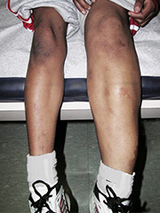 Parkes Weber Syndrome Image