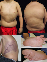 Proteus Syndrome Image