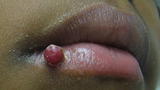 Pyogenic Granuloma Image