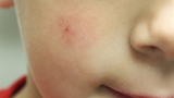 Spider Angioma Image