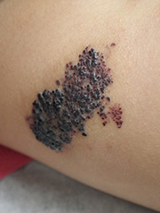 Venolymphatic Malformation Image