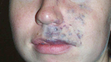 Venous Malformation Image