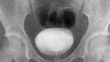 vcug ultrasound