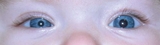 When Anisocoria Signals A Bigger Problem - Figure 1