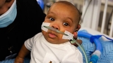 The World’s Smallest Pacemaker: Cameron’s Story