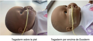 Una vez que la sonda esté colocada, fíjela con el Tegaderm. 