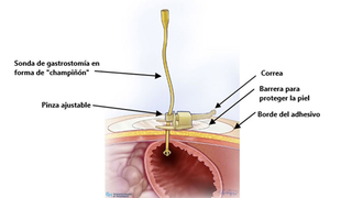 Changing a Hollister® Vertical Tube Attachment Device - Spanish