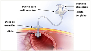 Sonda G de globo estándar (o larga) en el estómago