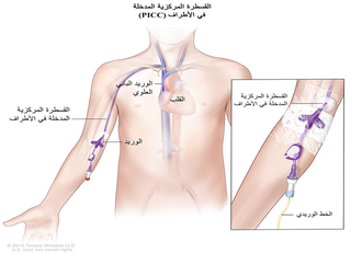 العناية بالقسطرة المركزية المدخلة في الأطراف (PICC)