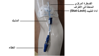 القسطرة المركزية المُدخَلة في الأطراف PICC مع Statlock (أبيض) لتثبيت الخط بالجلد.