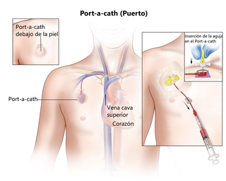 Catéter Venoso Implantable