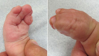 Complex syndactyly when fingers are webbed together baby with Apert Syndrome